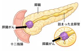 すい臓がんの早期発見